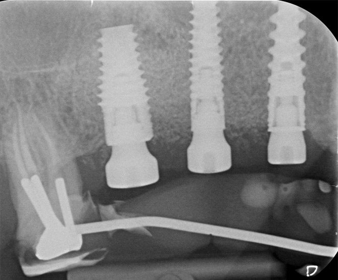 Radiographie pose implants