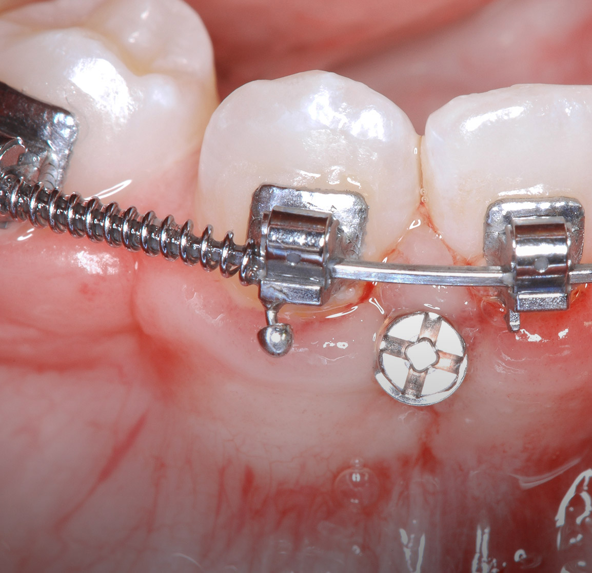 mini implants orthodontiques